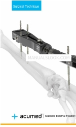 acumed Stableloc External Fixation System Surgical Technique